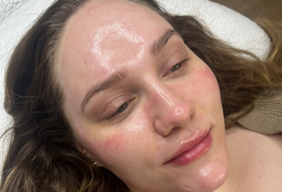 Cliniccare Microneedling Treatment